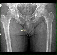 hip-joint-detection-hole project thumbnail