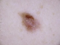 Skin Cancer project thumbnail