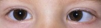 STRABISMUS project thumbnail