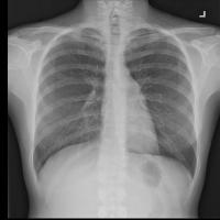 Vertebrae Landmark Detection project thumbnail