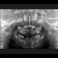 dental Object Detection Model by dental