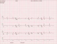 ECG Dataset project thumbnail
