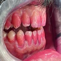 dental-plaque project thumbnail