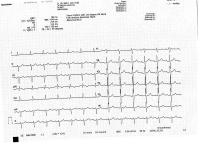 ECG Detction project thumbnail