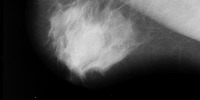 breast  project thumbnail