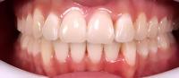 dental disease - detection project thumbnail