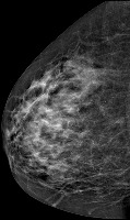 Breast Cancer Detection project thumbnail