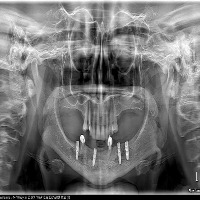 oral detection project thumbnail