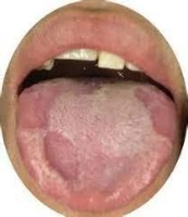 Tongue Condition 2 project thumbnail