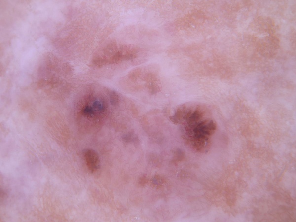Trigger Pattern Skin skin Classification Model by ham