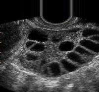 PCOS-Follicle-Detection project thumbnail