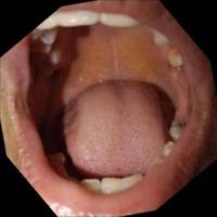 ORAL CANCER BY AMIT project thumbnail