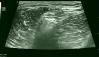 Popliteal Block project thumbnail