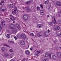 meningioma_detection_mitosis project thumbnail