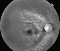 Fundus Images project thumbnail