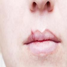 Lip Disease Project Object Detection Dataset by Lip disease Project