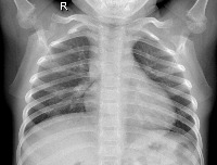 pneumonia12/10 project thumbnail