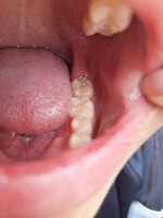 tooth caries 02 project thumbnail