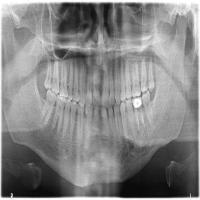 teeth-ident-merge project thumbnail