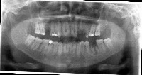 teeth project thumbnail