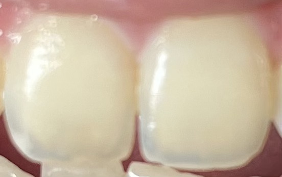 Incisal translucency Instance Segmentation Model by MDS