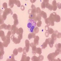 leukemia project thumbnail