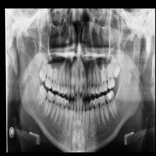 teeth Instance Segmentation Model by ShuiMoo