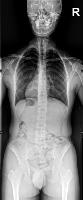 Spine ROI detector project thumbnail