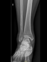 foot bone project thumbnail