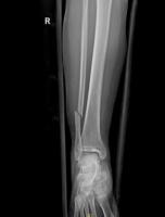 foot bone project thumbnail