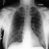 Tuberculosis Detection Classification Model by Hamza