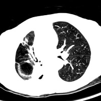 lung-cancer-dataset project thumbnail