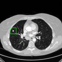 lung cancer project thumbnail