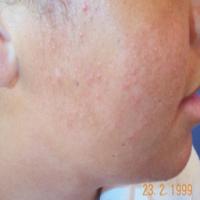 Acne Types Detector project thumbnail