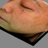 Detection of melasma  project thumbnail