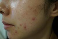 Acne Dataset project thumbnail