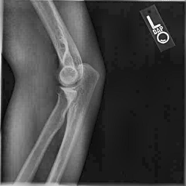 Bonefractureall2 Object Detection Dataset By Bone Fracture Detection Bonefractureall2 Object Detection Dataset By Bone Fracture Detection