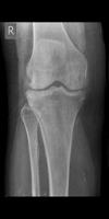 osteoporosis project thumbnail