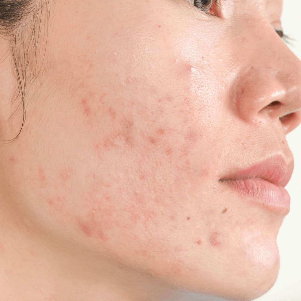 Acne vs Heat Bumps: Key Differences