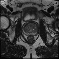 prostate-cancer-detection project thumbnail