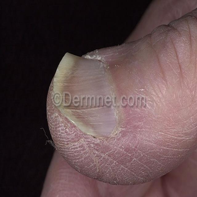 koilonychia_data Object Detection Dataset (v1, 20230302 615am) by