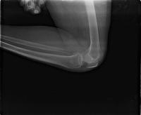 Knee (Lateral) project thumbnail