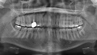 teeth project thumbnail