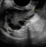 PCOS Detection project thumbnail