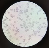 Sickle_cell_detection project thumbnail