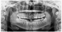 Bone Fracture Classification project thumbnail
