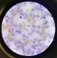 sickle cell unlabeled project thumbnail