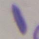 Sickle_cell_is project thumbnail