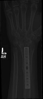 bone fracture detection -1 project thumbnail