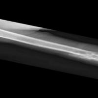fracture-detection project thumbnail